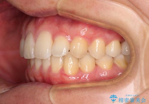 前歯のクロスバイトと抜歯が必要な奥歯の虫歯 インビザラインとインプラント治療の治療後