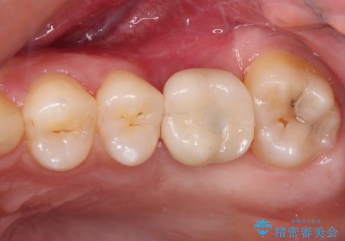 前歯のクロスバイトと抜歯が必要な奥歯の虫歯 インビザラインとインプラント治療の治療後