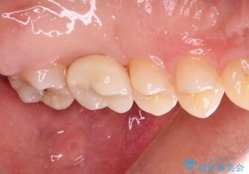 前歯のクロスバイトと抜歯が必要な奥歯の虫歯 インビザラインとインプラント治療の治療後
