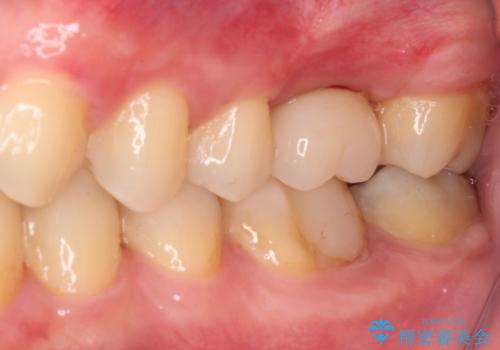 前歯のクロスバイトと抜歯が必要な奥歯の虫歯　インビザラインとインプラント治療の治療後