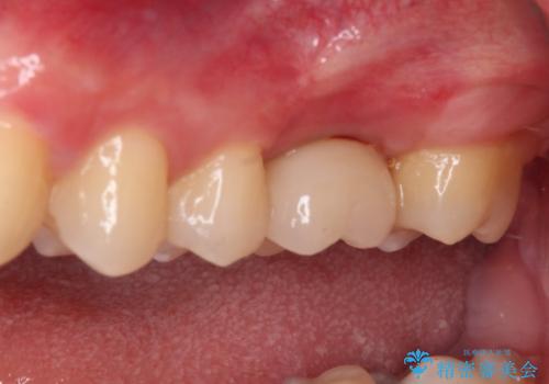 前歯のクロスバイトと抜歯が必要な奥歯の虫歯 インビザラインとインプラント治療の治療後