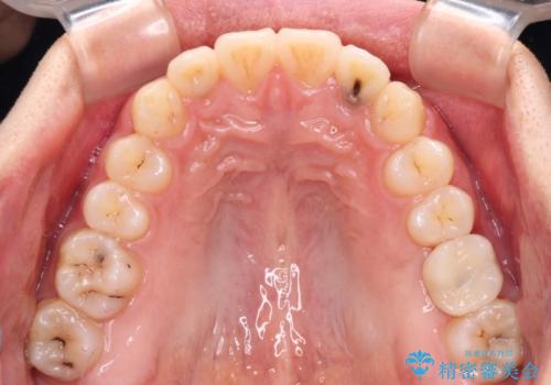 前歯のクロスバイトと抜歯が必要な奥歯の虫歯 インビザラインとインプラント治療の治療後