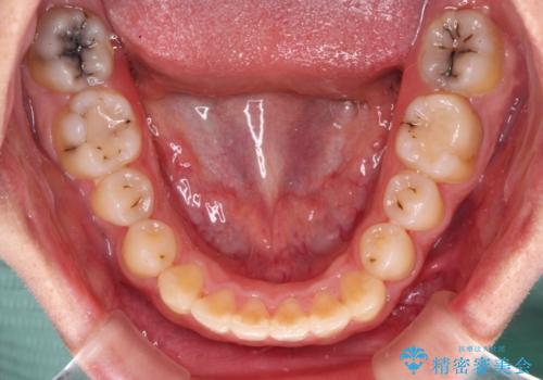 前歯のクロスバイトと抜歯が必要な奥歯の虫歯 インビザラインとインプラント治療の治療後