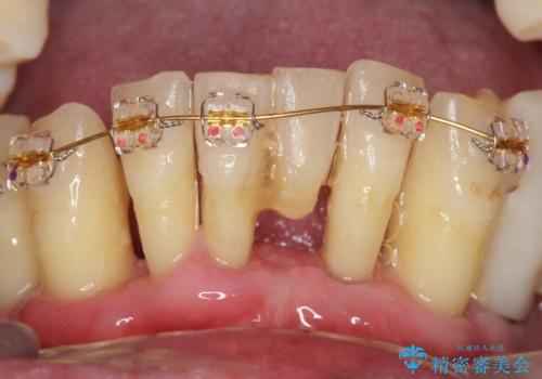 他院で抜歯と言われた歯　歯も神経も残したい　50代男性の治療中