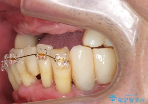 喫煙を再開してインプラント周囲炎に リカバリー治療 50代男性の治療前