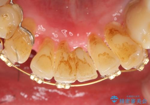 他院で抜歯と言われた歯 歯も神経も残したい 50代男性の治療中