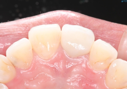 保険の被せ物をきれいにしたい オールセラミックの治療後