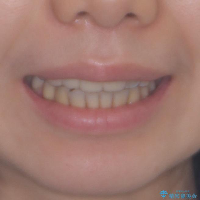 転んで前歯が欠けた 折れた前歯をきっかけに矯正治療で歯列をきれいに整えるの治療後(顔貌)