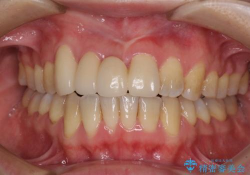 転んで前歯が欠けた　折れた前歯をきっかけに矯正治療で歯列をきれいに整える