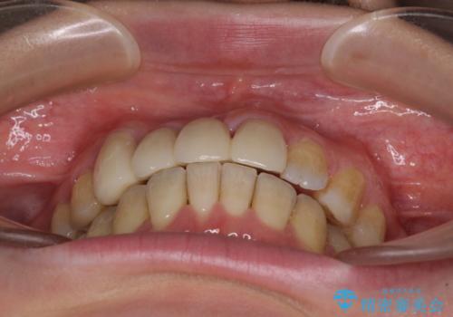 転んで前歯が欠けた 折れた前歯をきっかけに矯正治療で歯列をきれいに整えるの治療後