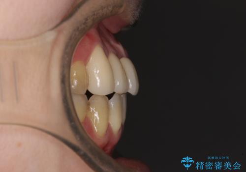 転んで前歯が欠けた　折れた前歯をきっかけに矯正治療で歯列をきれいに整えるの治療後