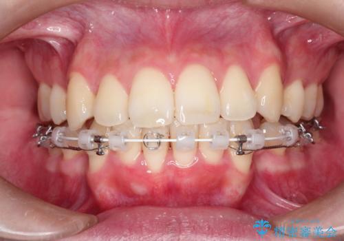 口元が出てるの気になる ハーフリンガルによる抜歯矯正での横顔改善の治療中