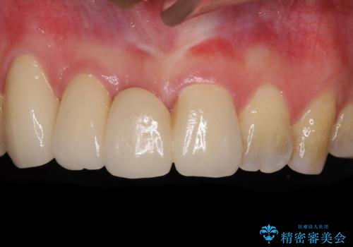 転んで前歯が欠けた 折れた前歯をきっかけに矯正治療で歯列をきれいに整えるの症例 治療後
