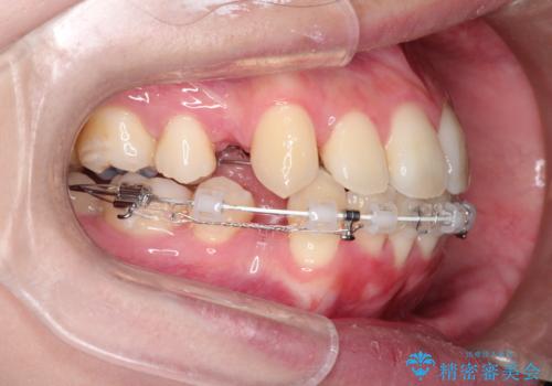 口元が出てるの気になる ハーフリンガルによる抜歯矯正での横顔改善の治療中