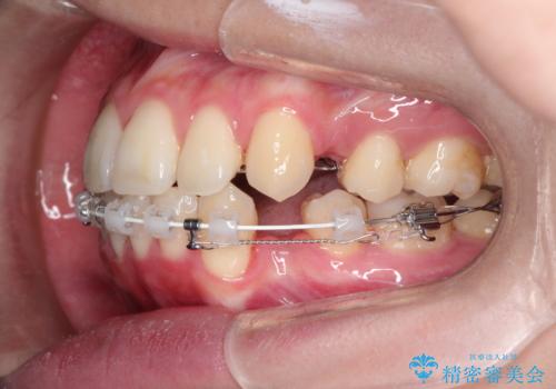 口元が出てるの気になる ハーフリンガルによる抜歯矯正での横顔改善の治療中