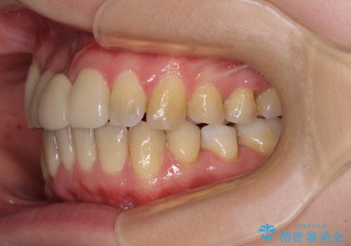 転んで前歯が欠けた 折れた前歯をきっかけに矯正治療で歯列をきれいに整えるの治療後