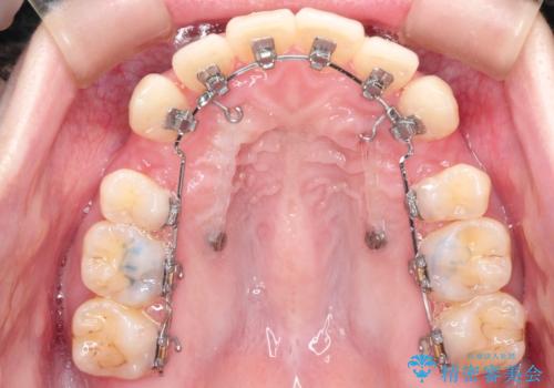 口元が出てるの気になる ハーフリンガルによる抜歯矯正での横顔改善の治療中