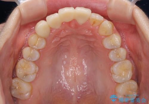 転んで前歯が欠けた 折れた前歯をきっかけに矯正治療で歯列をきれいに整えるの治療後