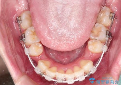 口元が出てるの気になる ハーフリンガルによる抜歯矯正での横顔改善の治療中