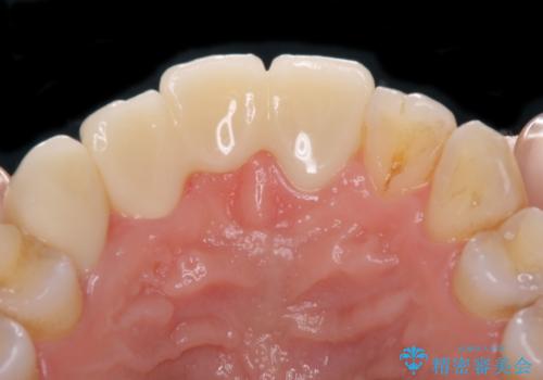 転んで前歯が欠けた 折れた前歯をきっかけに矯正治療で歯列をきれいに整えるの治療後