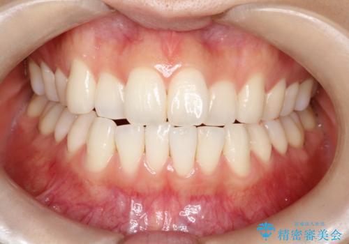 オフィスホワイトニング スペシャルコース トリートメント付きの症例 治療前