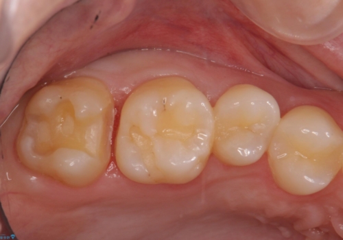 奥歯の虫歯　歯の間を広げてセラミックでしっかり治療の治療中
