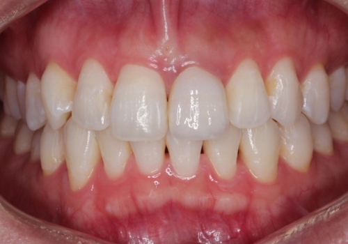 保険の被せ物をきれいにしたい オールセラミックの治療後