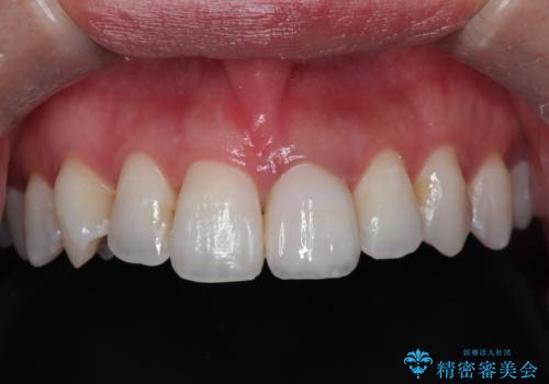 保険の被せ物をきれいにしたい オールセラミックの症例 治療後