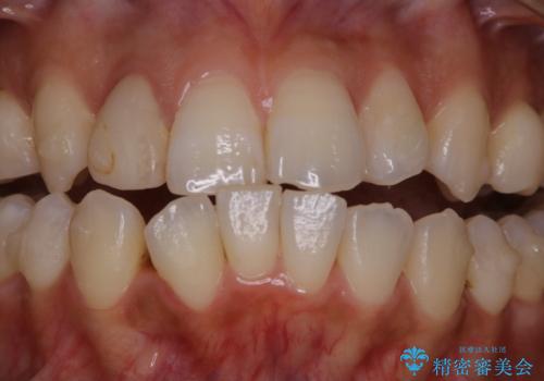 インビザライン中にステイン落としの治療前