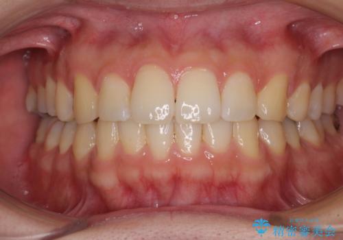 インビザライン・ライトによる矯正治療の後戻り改善の症例 治療後