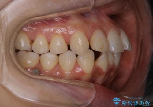 インビザライン中にステイン落としの治療前
