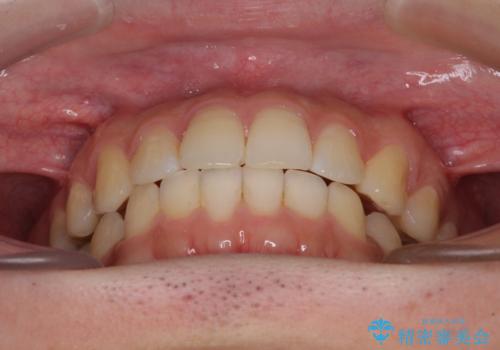 インビザライン・ライトによる矯正治療の後戻り改善の治療後