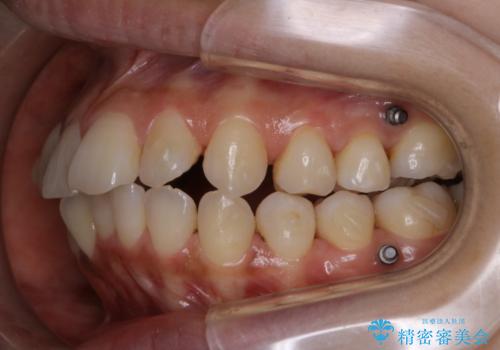 インビザライン中にステイン落としの治療前