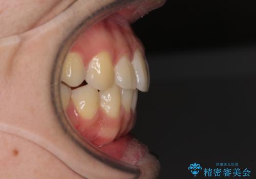 インビザライン・ライトによる矯正治療の後戻り改善の治療後
