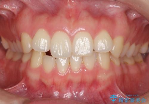 下の前歯が1本短い インビザラインと部分矯正の組み合わせの症例 治療前