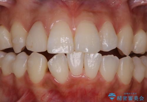 インビザライン中にステイン落としの治療後