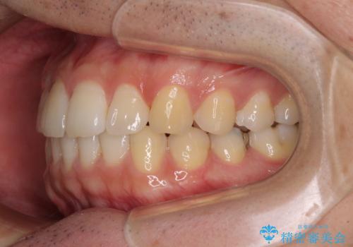 インビザライン・ライトによる矯正治療の後戻り改善の治療後