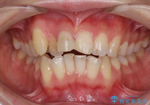 転んで前歯が欠けた 折れた前歯をきっかけに矯正治療で歯列をきれいに整えるの治療前