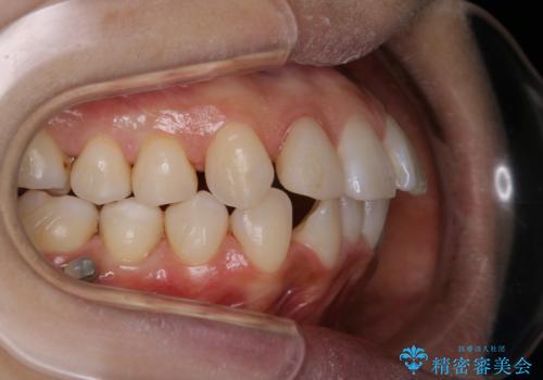 インビザライン中にステイン落としの治療後