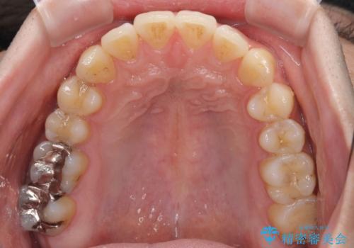 インビザライン・ライトによる矯正治療の後戻り改善の治療後