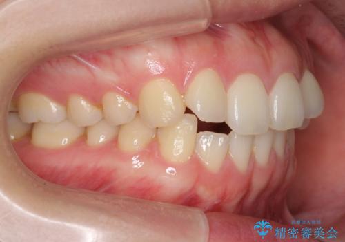 下の前歯が1本短い　インビザラインと部分矯正の組み合わせ
