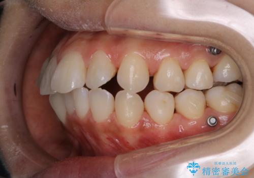 インビザライン中にステイン落としの治療後