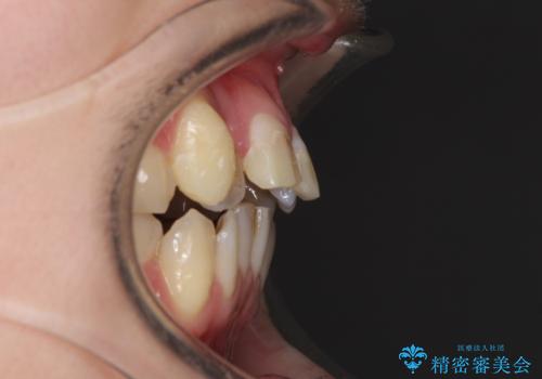 転んで前歯が欠けた 折れた前歯をきっかけに矯正治療で歯列をきれいに整えるの治療前