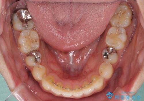 インビザライン・ライトによる矯正治療の後戻り改善の治療後