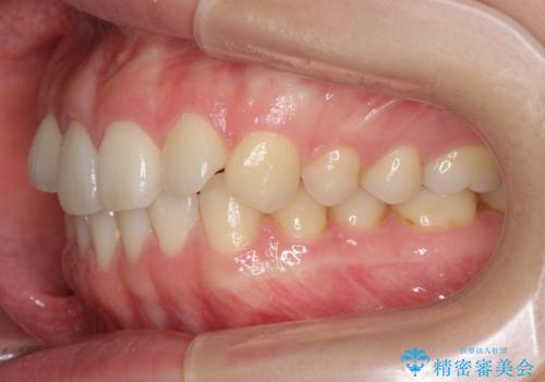 下の前歯が1本短い　インビザラインと部分矯正の組み合わせの治療前