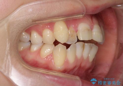 転んで前歯が欠けた 折れた前歯をきっかけに矯正治療で歯列をきれいに整えるの治療前