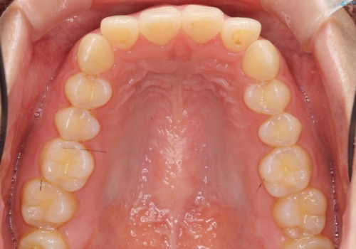 下の前歯が1本短い インビザラインと部分矯正の組み合わせの治療前