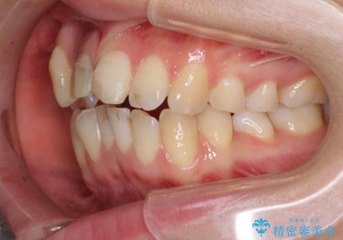 転んで前歯が欠けた 折れた前歯をきっかけに矯正治療で歯列をきれいに整えるの治療前