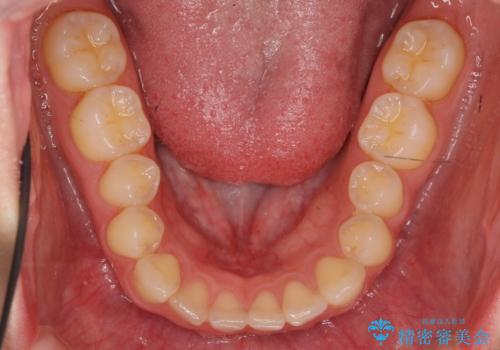 下の前歯が1本短い　インビザラインと部分矯正の組み合わせの治療前