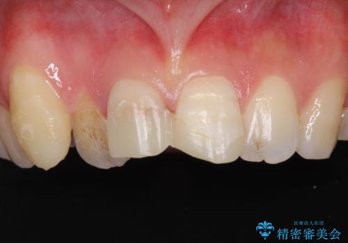 転んで前歯が欠けた　折れた前歯をきっかけに矯正治療で歯列をきれいに整えるの症例 治療前
